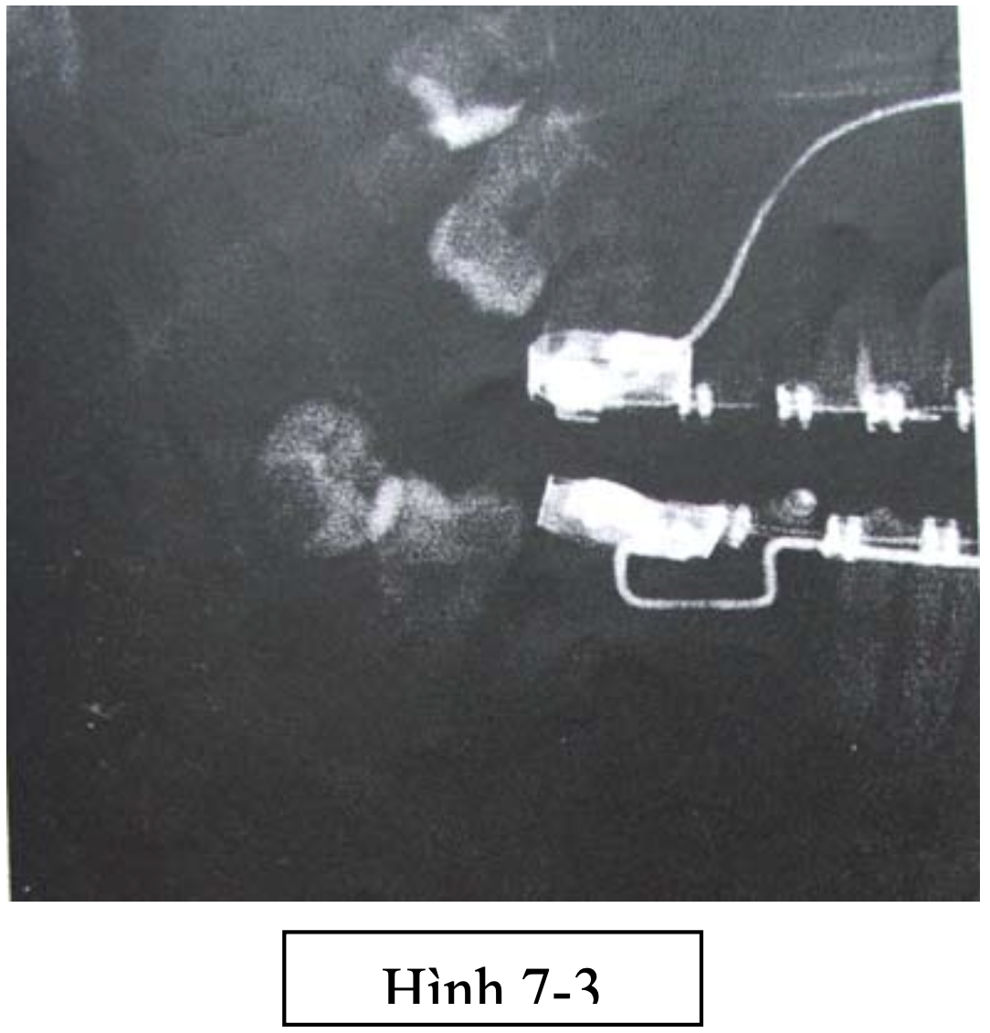 Lấy mầm răng trong điều trị chỉnh hình, khi cần thêm khoảng trống sau hàm (hình 7- 3). Lấy mầm răng còn giúp R7 mọc hoàn toàn và đúng vị trí hay khi mầm răng bất thường một cách có ý nghĩa (hình 7-4; 7- 5a; 7-5b).
